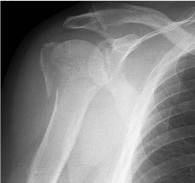 Radiografia do ombro com fratura do úmero proximal.