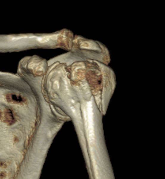 Tomografia computadorizada com fratura do úmero (ombro) proximal