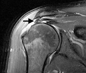 Ressonância magnética demonstrando lesão do tendão supraespinal