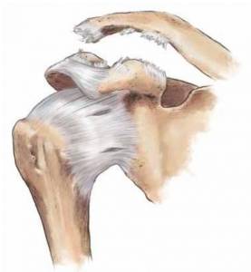Figura demonstrando a lesão dos ligamentos estabilizadores da articulação acromioclavicular