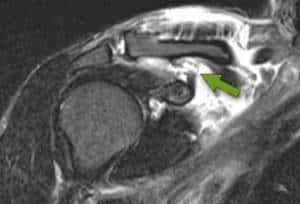 Ressonância magnética do ombro demonstrando ruptura dos ligamentos coracoclaviculares