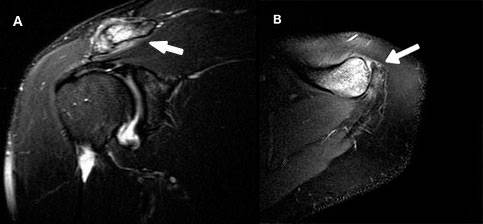 Ressonância magnética demostrando osteólise da clavícula – corte coronal (A), corte axial (B)