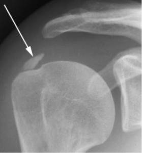Radiografia demonstrando calcificação no tendão supraespinal