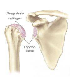 desgaste da cartilagem causando dor no ombro