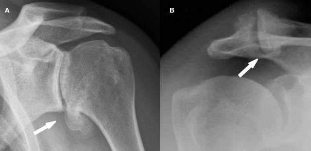 A) Artrose do ombro (glenoumeral) B)Artrose acromioclavicular