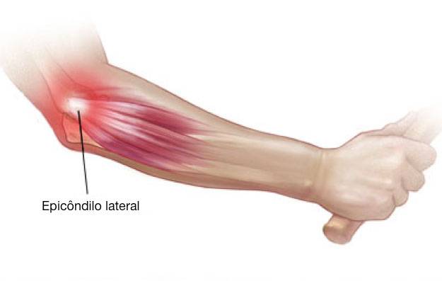 Epicôndilo lateral, origem dos músculos extensors do antebraço