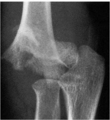 Radiografia de fratura supracondiliana do cotovelo em criança