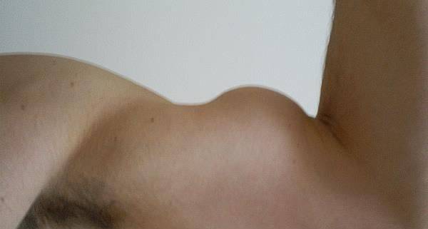Lesão do biceps com sinal do Popeye
