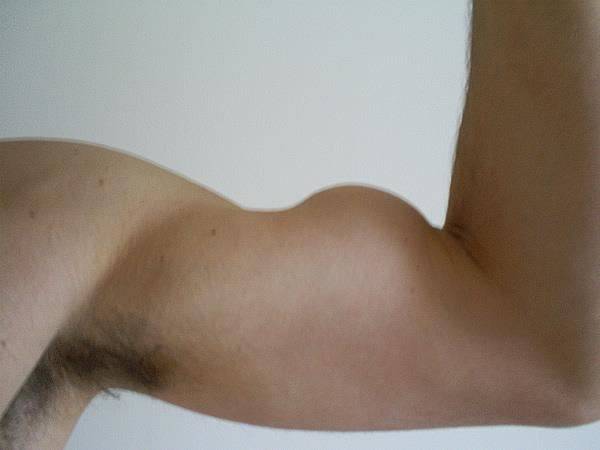 Lesão do biceps com sinal do Popeye