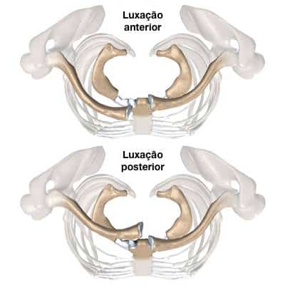 Luxação esternoclavicular anterior e posterior