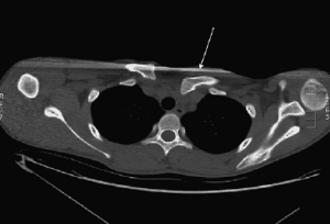 Tomografia computadorizada demostrando luxação esternoclavicular posterior