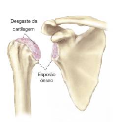 Na artrose do ombro ocorre um desgaste da cartilagem