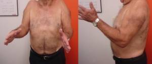 Paciente com artropatia do manguito rotador bilateral e “psedoparalisia do ombros”.