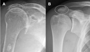 Radiografia do ombro. A) artropatia do manguito rotador com a cabeça do úmero mais alta, encostada no acrômio; B) ombro normal