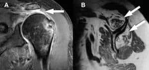 Ressonância magnética do ombro com artropatia do manguito rotador. A) Rotura do tendão supraespinal com grande retração (seta). B) Degeneração gordurosa dos músculos supraespinal e infraespinal.