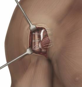 Tratamento cirúrgico da lesão do músculo peitoral maior