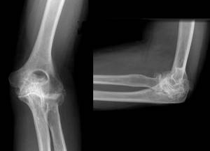 Radiografia do cotovelo com sinais de artrose no cotovelo