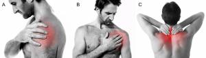 Locais comuns de dor por doenças do ombro (A e B) e por doenças da coluna cervical (C)