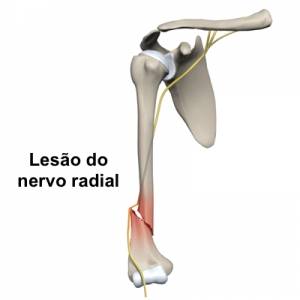 Lesão do nervo radial