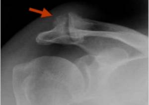 Legenda: Radiografia com sinais da artrose acromioclavicular