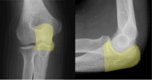 Radiografias do cotovelo (olecrano em amarelo)