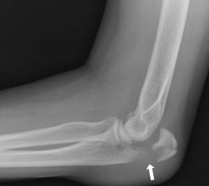 Radiografia do cotovelo demonstrando uma fratura do olecrano (seta)