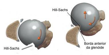 Figura demonstrando como surge uma lesão de Hill-Sachs com a colisão da cabeça do úmero contra a glenóide