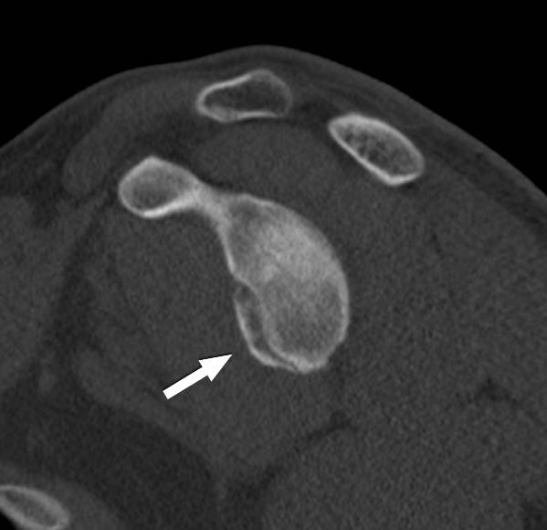 Tomografia computadorizada evidenciando lesão de Bankart ósseo (seta branca)