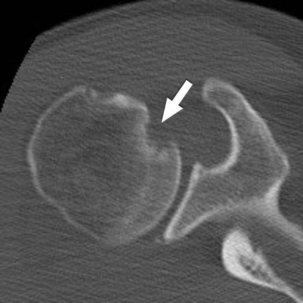 Tomografia computadorizada demostrando lesão de Hill-Sachs reverso