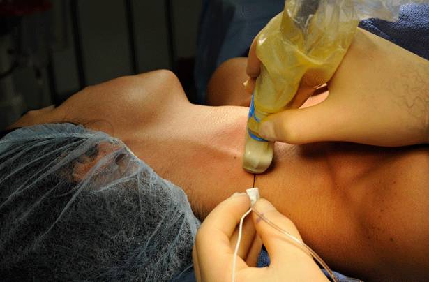 Bloqueio do plexo braquial na cirurgia para luxação do ombro
