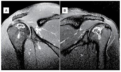 Relato inédito de um paciente com osteonecrose multifocal associada à exposição ocupacional crônica ao alumínio