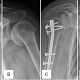 Estudo de integridade do tendão supraespinal em pacientes submetidos à fixação de fraturas da extremidade proximal do úmero