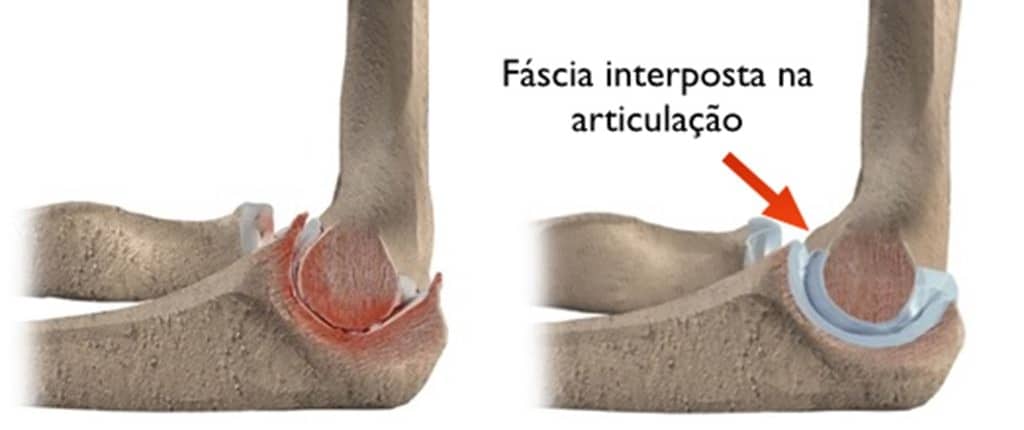 Como fica a estrutura articular após a artroplastia de interposição