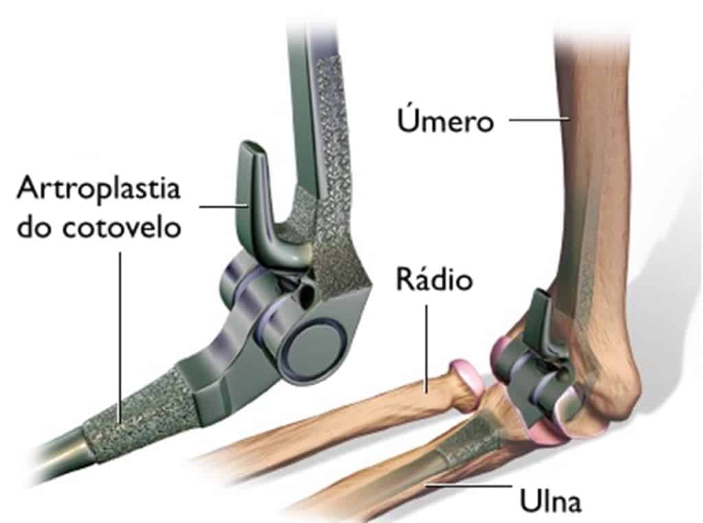 Procedimento de artroplastia com prótese