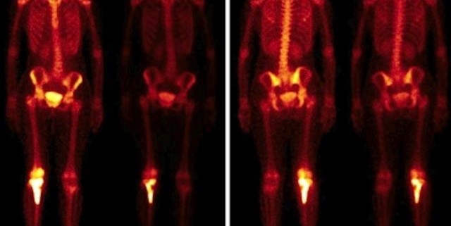 cintilografia óssea é um exame de imagem que utiliza quantidades baixas de radiação para diagnosticar possíveis alterações nos ossos do paciente