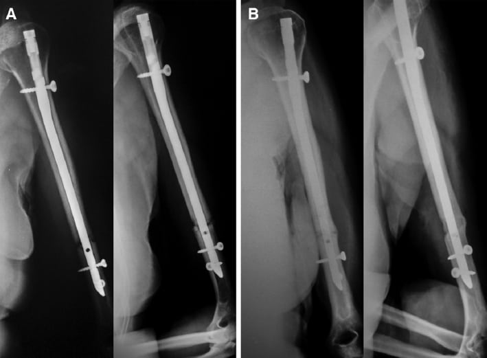 Immediate (A) and 1-year (B) postoperative radiographs of humeral shaft fracture treated by IMN.