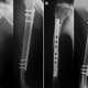 Immediate (A) and 1-year (B) postoperative radiographs of humeral shaft fracture treated by MIPO.