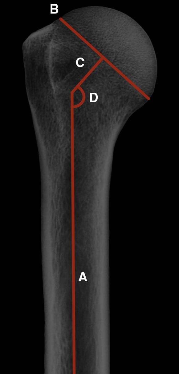 Figura 4 Medições do ângulo cabeça-diáfise: eixo diafisário do úmero (A), colo anatômico (B), perpendicular do colo anatômico (C), e ângulo cabeça-diáfise (D).