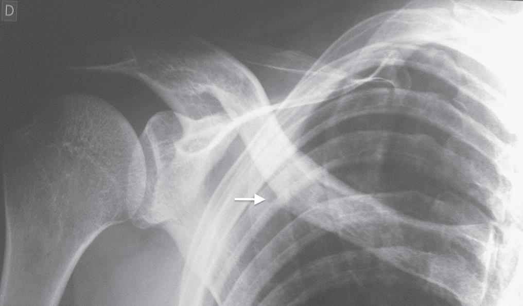 Figura 4. — Radiografia realizada 6 meses após a fratura mostra a cicatrização óssea.