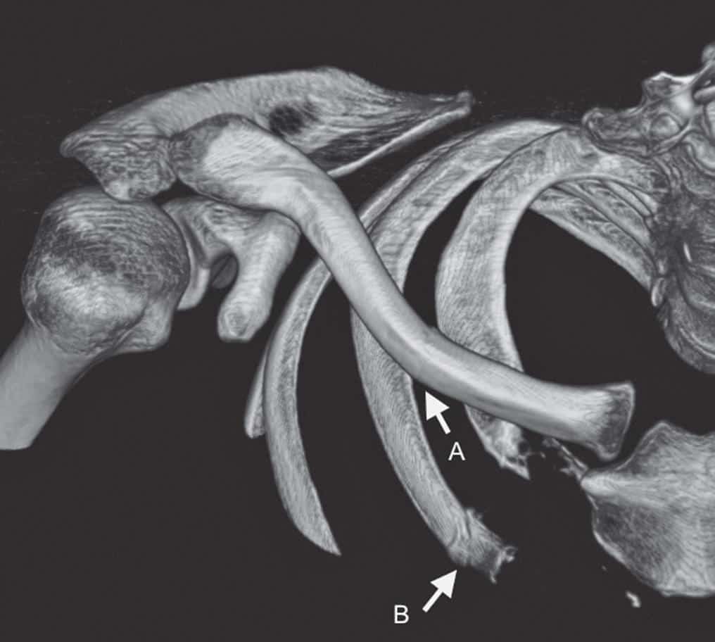 Figura 3. —Tomografia computadorizada tridimensional que apresenta as fraturas da clavícula (a) e da segunda costela (b).