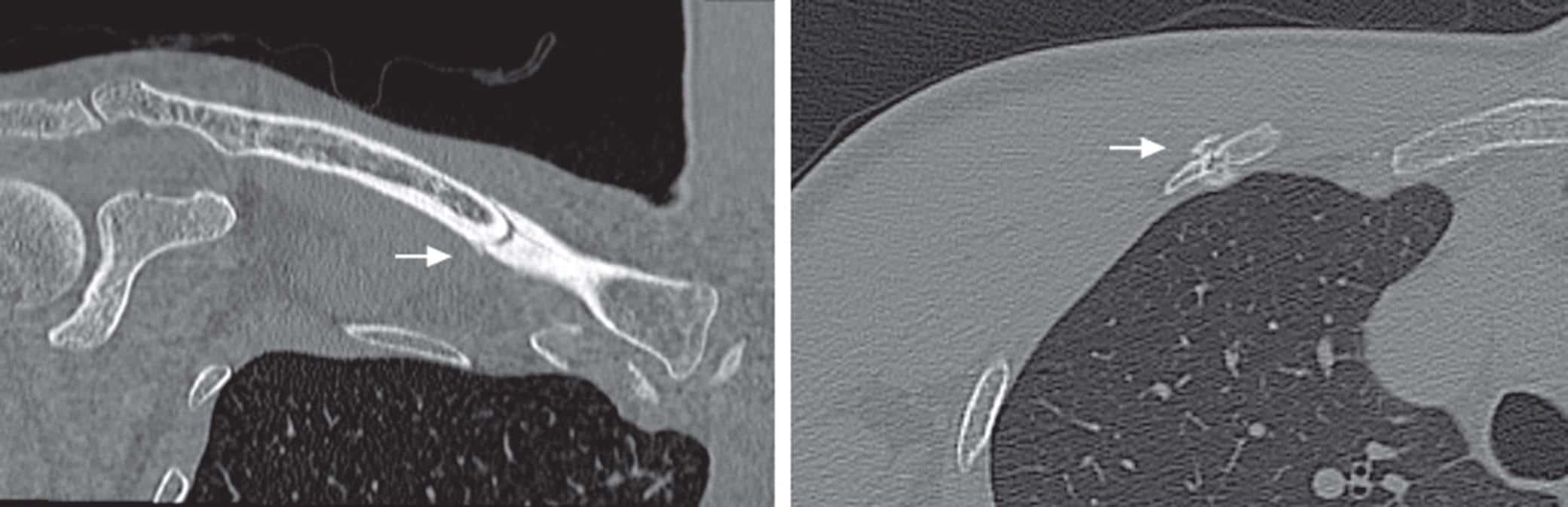 Figura 2. — tomografia computorizada que mostra a clavícula e a fratura da segunda costela a) visão coronal que mostra a fratura da clavícula; b) visão axial que mostra a se a fratura da costela.