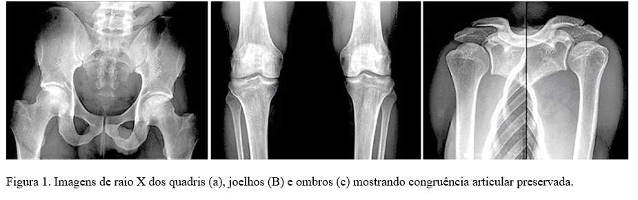 Figura 1. Imagens de raio X dos quadris (a), joelhos (B) e ombros (c) mostrando congruência articular preservada.