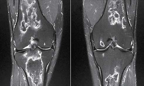 Figura 3. Imagem de ressonância magnética dos joelhos mostrando o acometimento bilateral sem colapso das articulações: A) direita, B) esquerda.