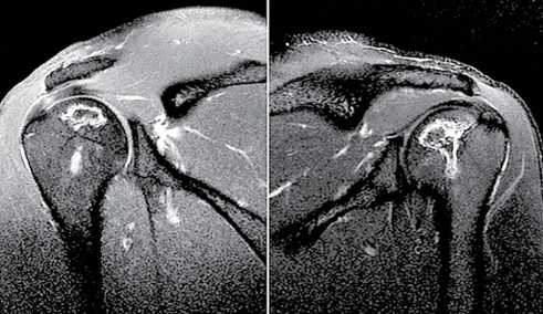 Figura 4. Imagem de ressonância magnética dos ombros mostrando o acometimento bilateral sem colapso das articulações: A) direita, B) esquerda.